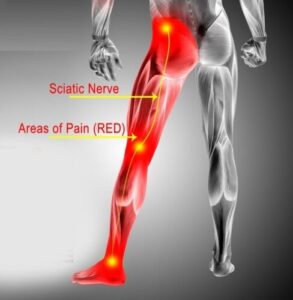 Sciatia pain starts in the low back and radiates down the leg.
