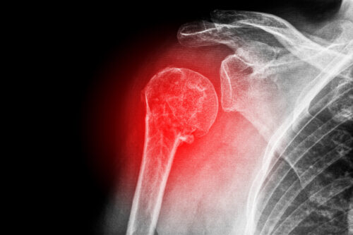 How To Cure A Frozen Shoulder