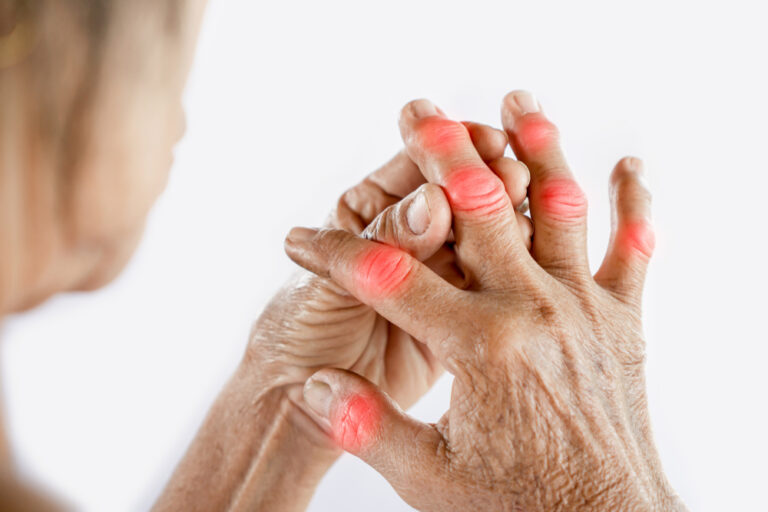 A woman suffering from rheumatoid arthritis.