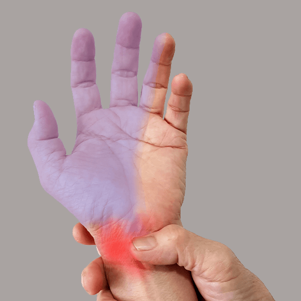 Carpal Tunnel Syndrome affecting the thumb and fingers