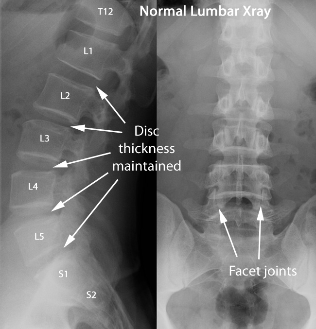 X-ray images showing a normal lumbar spine