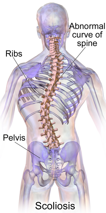 An image showing a spinal scoliosis