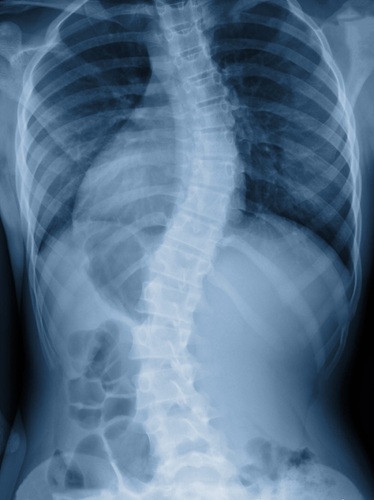 An X-ray image of a spinal scoliosis