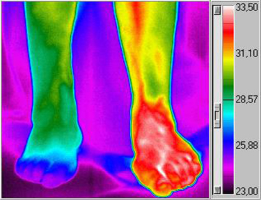 A person with circulation disease causing neuropathy.